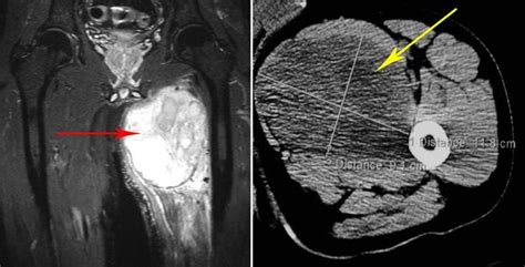 imaging tests for adult soft tissue sarcoma|are soft tissue sarcomas hard.